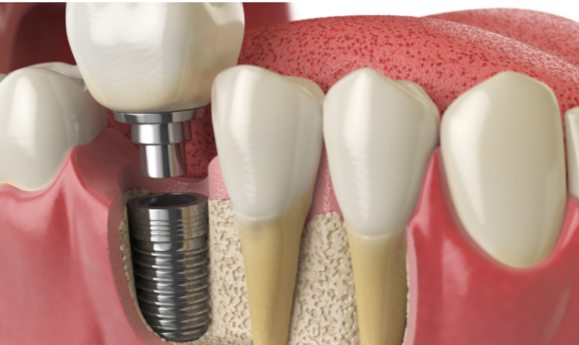 A close-up of dental implants performed at Bespoke Dental Newnan